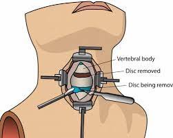 anterior cervical discectomy and fusion cost in india