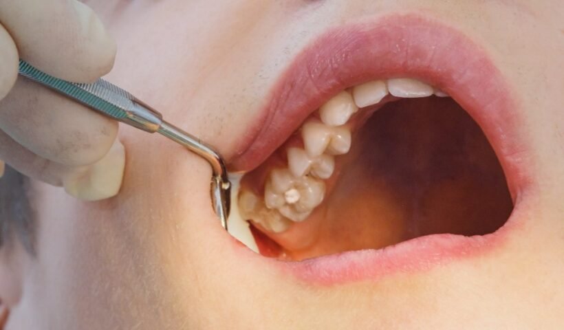 Partial Dentures