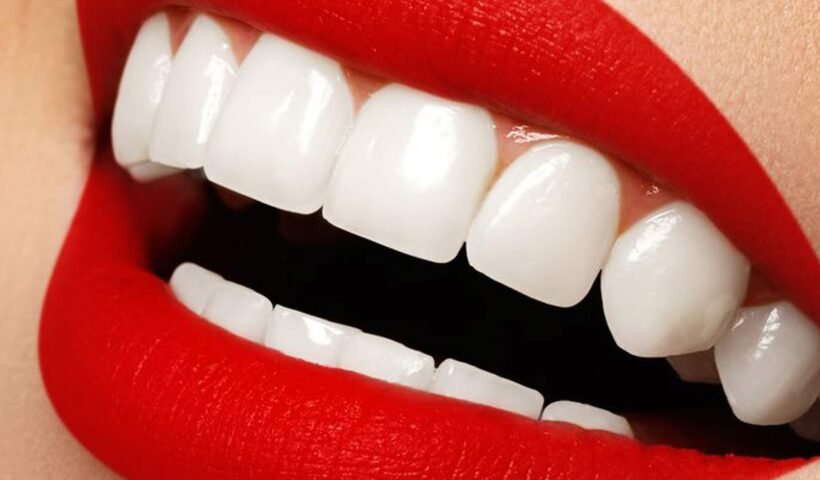 Porcelain Veneers in Dubai