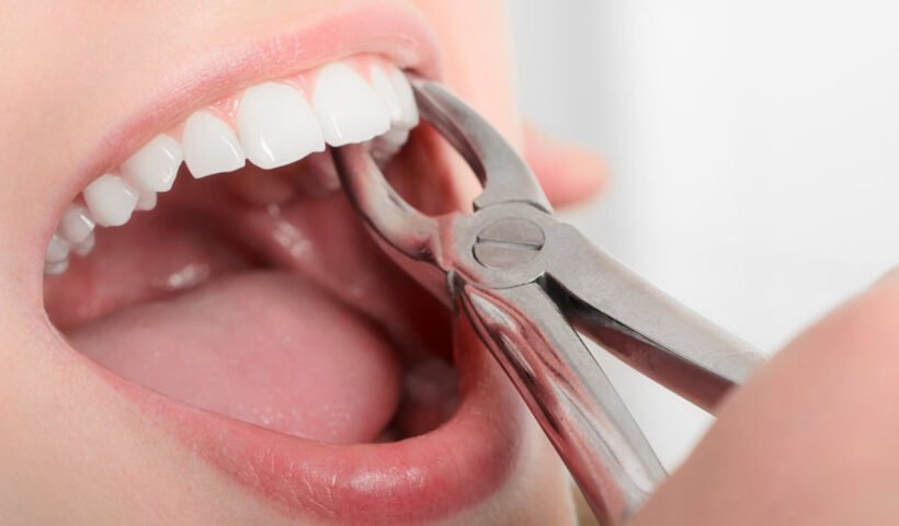 dental extraction NYC