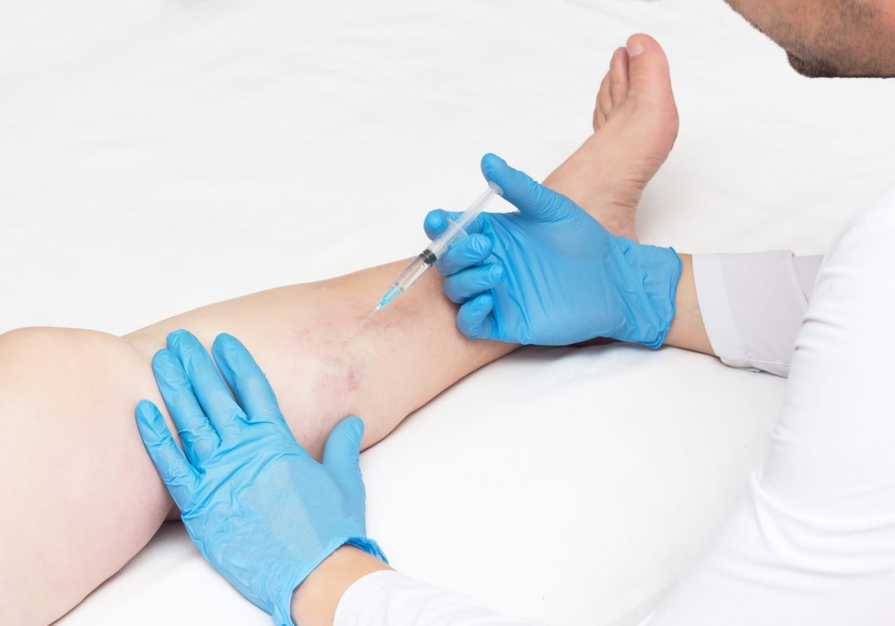 Are varicose veins covered by insurance?